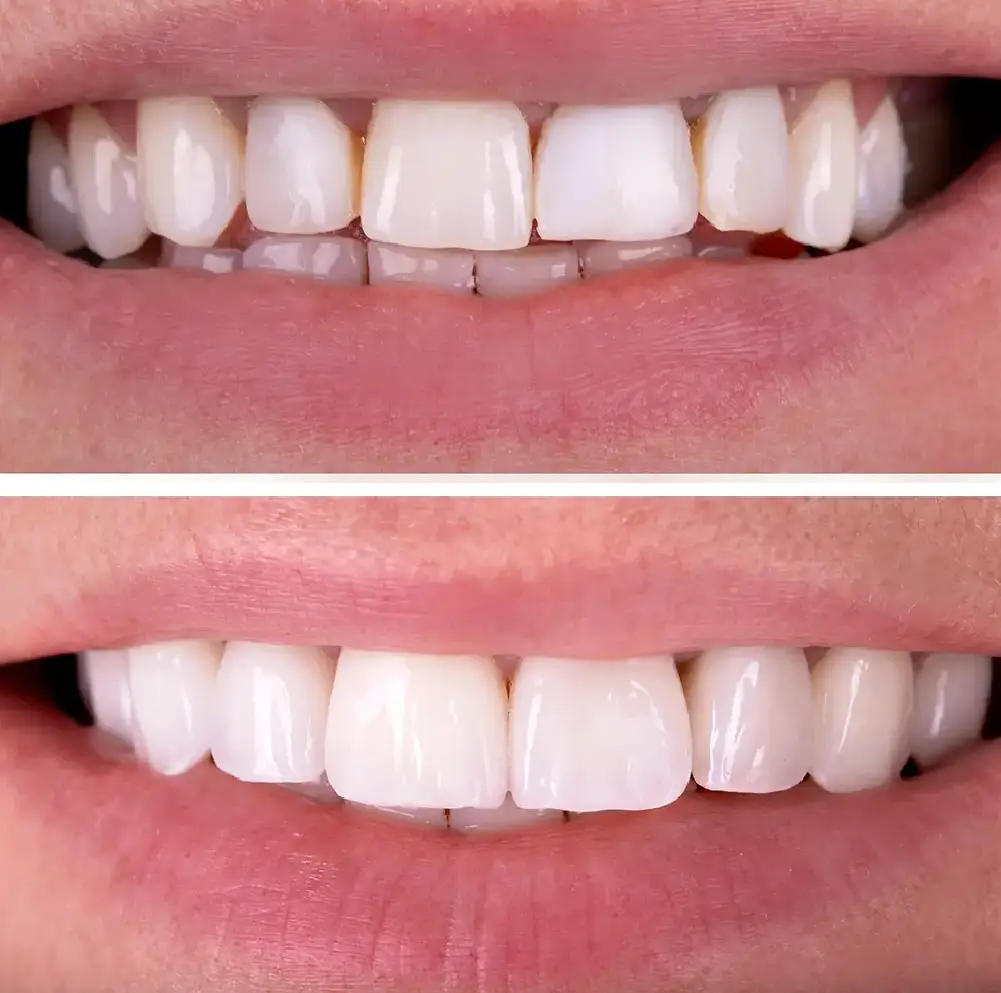Before and After Before and After