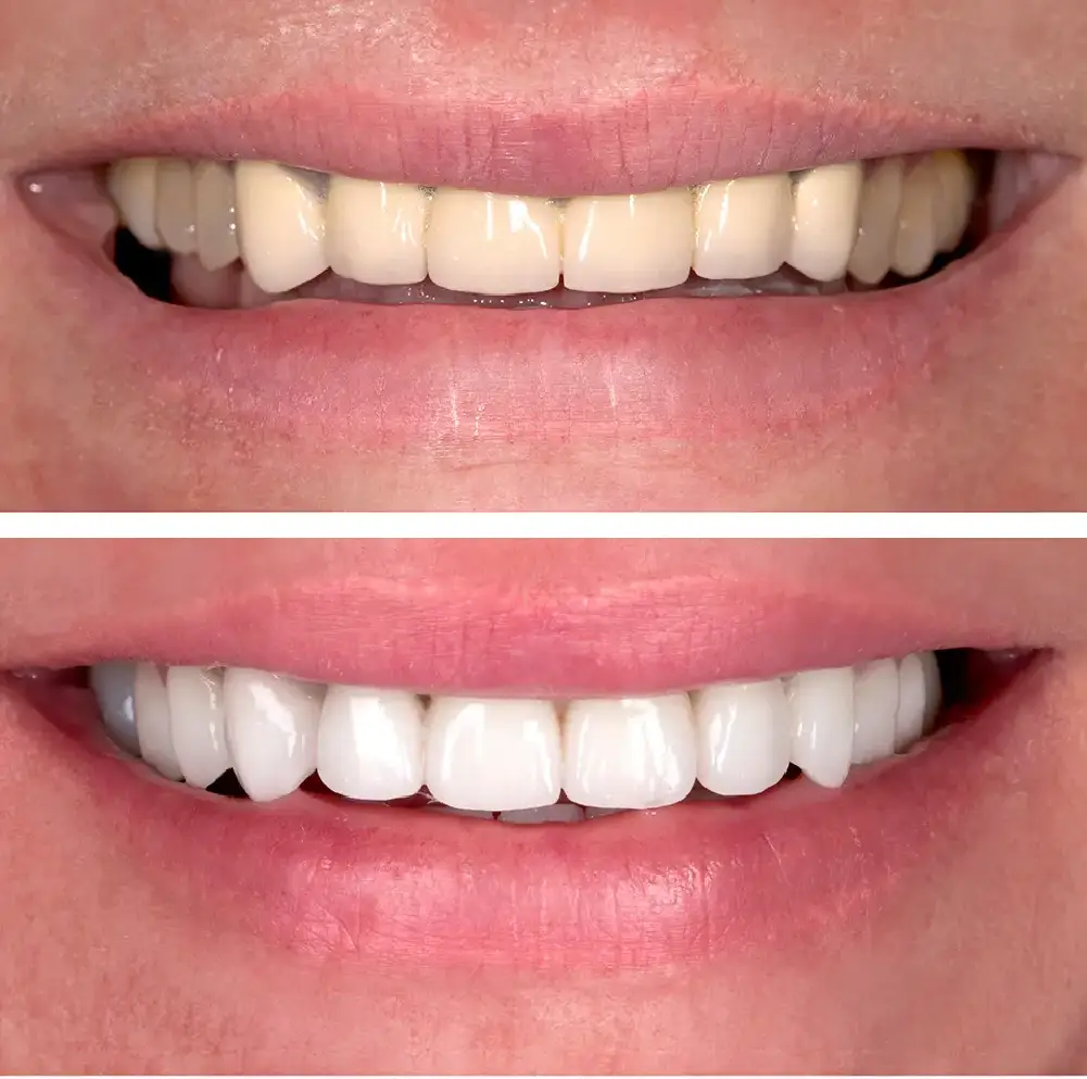Before and After Before and After